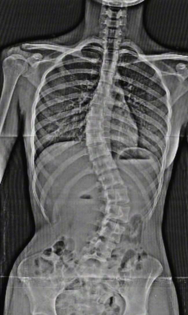 Nada juga memamerkan hasil foto rontgen tulang belakangnya yang jelas terlihat bengkok ke samping. Skoliosis yang dideritanya itu sampai membuatnya merasa sakit sekalipun tidak melakukan aktivitas apa-apa. Foto: Instagram/@nada_tarina_putri