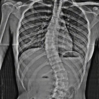 Nada juga memamerkan hasil foto rontgen tulang belakangnya yang jelas terlihat bengkok ke samping. Skoliosis yang dideritanya itu sampai membuatnya merasa sakit sekalipun tidak melakukan aktivitas apa-apa. Foto: Instagram/@nada_tarina_putri