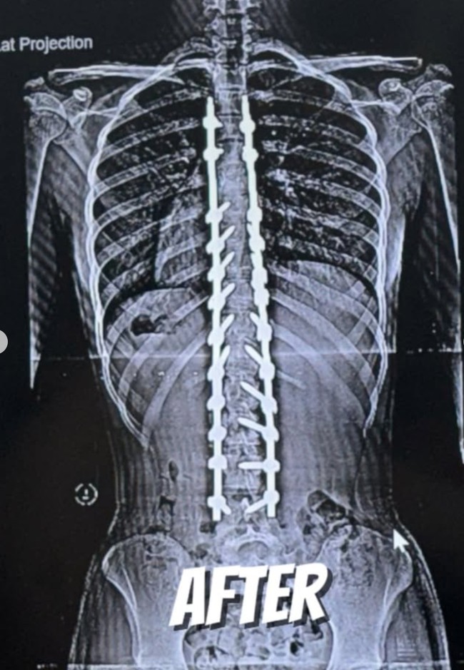 Nada juga memperlihatkan hasil rontgen tulang belakangnya setelah operasi. Kini tulang belakangnya itu tampak sudah lurus. Foto: Instagram/@nada_tarina_putri