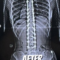 Nada juga memperlihatkan hasil rontgen tulang belakangnya setelah operasi. Kini tulang belakangnya itu tampak sudah lurus. Foto: Instagram/@nada_tarina_putri