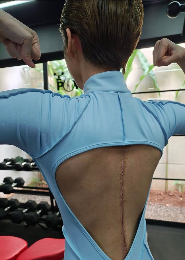 Kini sudah 1 bulan setelah operasi, Nada pun sudah kembali menjalani aktivitasnya seperti biasa. Terlihat ia memamerkan jahitan panjang di punggung hasil operasi skoliosis. Foto: Instagram/@nada_tarina_putri