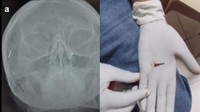 Perempuan 50 tahun pergi ke rumah sakit dengan keluhan nyeri leher dan kepala lebih dari satu tahun. Setelah dilakukan pemeriksaan mendalam, dokter menemukan sebuah benda asing di kepalanya. Terungkap, pasien pernah mengalami trauma 10 tahun lalu dan tidak mengetahui ada paku tertinggal dalam kepalanya. (Foto: F1000 Research)
