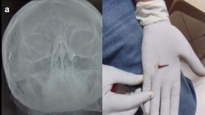 Penampakan benda asing yang ditemukan dalam tubuh.