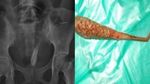 Foto-foto Rontgen Temuan Benda Aneh dalam Tubuh, Paku hingga Kawat Besi