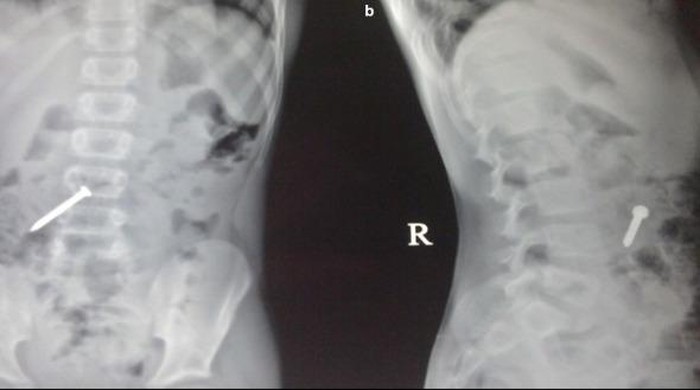 Penampakan benda asing yang ditemukan dalam tubuh.