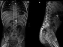 Foto-foto Rontgen Temuan Benda Aneh dalam Tubuh, Paku hingga Kawat Besi