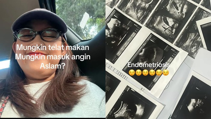 Viral Wanita Usia 20-an Ngeluh Begah Dikira Asam Lambung, Tak Tahunya Endometriosis