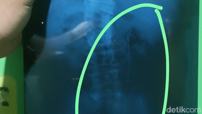 Viral di Pekalongan Warga Kabupaten Pekalongan viral karena sempat divonis menderita HIV usai menjalani operasi kencing batu, Jumat (26/9/2025).