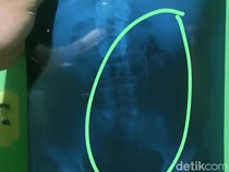 Penampakan Selang di Tubuh Pria Batang Dituding Bikin Kencing Darah-Divonis HIV