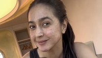 Inilah perawatan yang Nabila dan Yasmine lakukan di Gangnam, Seoul. Mereka menjalani perawatan stemcell therapy yang lagi hype di Korea. Mereka akan treatment menggunakan darah sendiri untuk perawatan antiaging agar kulit lebih elastis, sirkulasi lancar, dan tampak sehat alami. Begini bentuk wajah mereka setelah perawatan, masih banyak merah-merah. Foto: Instagram @yaswildblood dan @nsyakieb85