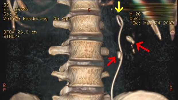 Contoh selang DJ Stent (panah kuning).