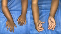 Pemeriksaan chromosomal breakage untuk anemia Fanconi menunjukkan hasil negatif, dan tidak ditemukan trombositopenia maupun ginjal tapal kuda pada pemeriksaan ultrasonografi. Pasien merupakan anak pertama dari pernikahan non-konsanguinitas, tanpa riwayat keluarga dengan kelainan bawaan serupa.Foto: jurnal PlumX Metrics