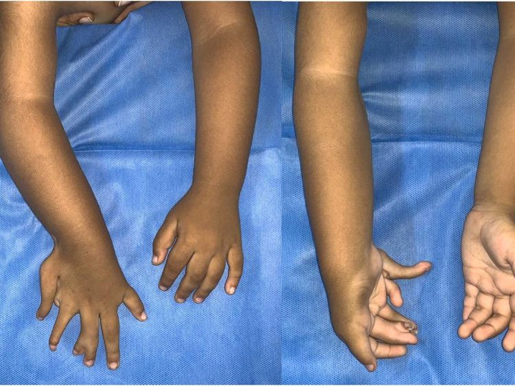 Foto Anak 2 Tahun Terlahir dengan Kondisi Langka, Punya Banyak Jari dan Tulang Lengan