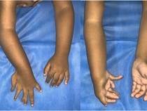 Foto Anak 2 Tahun Terlahir dengan Kondisi Langka, Punya Banyak Jari dan Tulang Lengan