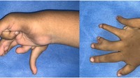 Selain itu, rontgen tangan menunjukkan duplikasi tipe III pada jari tengah, duplikasi tipe V pada jari manis, jari kelingking yang mengalami deviasi ulnar, serta pergelangan tangan dengan tiga tulang. Sementara itu, anggota gerak atas kiri, wajah, tulang belakang, panggul, dan ekstremitas bawah tampak normal. Pasien tidak mengalami obesitas, dan hasil parameter darah berada dalam batas normal.Foto: jurnal PlumX Metrics