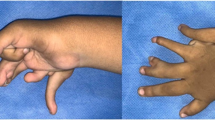 Anak india terlahir langka