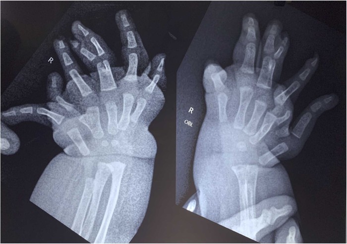 Anak india terlahir langka