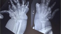 Berdasarkan hasil pemeriksaan, terlihat adanya pengecilan otot yang nyata di sekitar bahu dan skapula, disertai tidak adanya gerakan aktif pada abduksi, fleksi, maupun rotasi bahu. Siku dalam posisi fleksi 30 derajat tanpa kemampuan melakukan supinasi maupun pronasi. Lengan bawah dan pergelangan tangan tampak melebar.Foto: jurnal PlumX Metrics