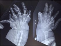 Bayi di India Lahir dengan Banyak Jari Tangan, Ini Penampakannya