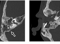 Merinding! Dokter Temukan Banyak Belatung Bersarang di Telinga Pria Ini
