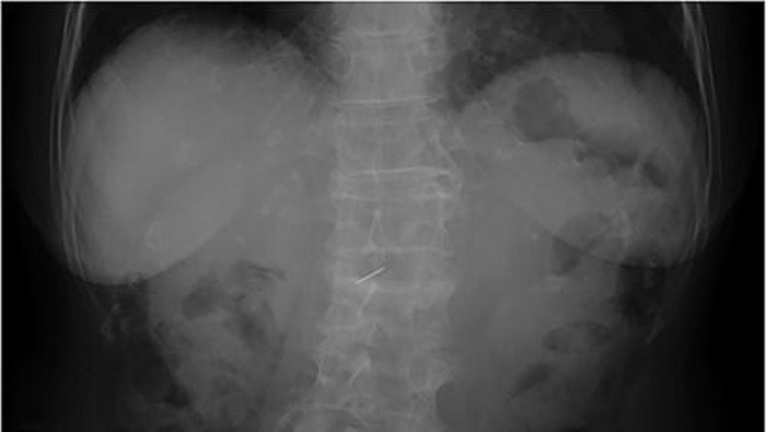 Jarum di dalam tubuh pasien.