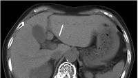 Pemeriksaan CT-scan menunjukkan benda asing mirip jarum menancap miring dari permukaan bawah liver menuju segmen lateral. Tidak tampak adanya nanah maupun tanda infeksi. (Foto: Journal of Surgical Case Reports)