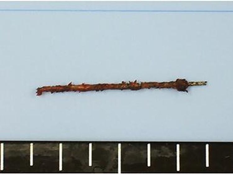 Penampakan Jarum Jahit Nyangkut di Liver Nenek Umur 81, Masuk Lewat Mana?