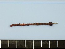 Jarum Jahit 3 Cm Ditemukan Bersarang di Liver Nenek 81 Tahun