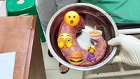 Potongan lambung ibunda Tasya yang dipotong. Lambung ibunda Tasya kini hanya 15 persen. Foto: Instagram @tasyakamila