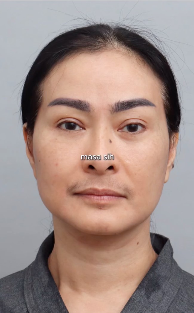 Iis juga membagikan foto wajahnya sebelum tindakan. Hiii …aku Lagi mau cerita-cerita nih tentang pengalaman aku beberapa bulan lalu. Kemarin aku sempat coba treatment stem cell di klinik langgananku. Awalnya mikir, apa iya sih seampuh itu?. Ternyata, seiring berjalannya waktu, hasilnya makin kelihatan. Gak cuma instan, tapi efeknya beneran permanen, dan yang paling aku suka, makin lama makin bagus! Kulit jadi kenyal, cerah, dan berasa balik ke beberapa tahun lalu, hehe, tulis keterangan dalam unggahannya. Foto: Instagram/@isdadahlia