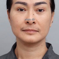 Iis juga membagikan foto wajahnya sebelum tindakan. Hiii …aku Lagi mau cerita-cerita nih tentang pengalaman aku beberapa bulan lalu. Kemarin aku sempat coba treatment stem cell di klinik langgananku. Awalnya mikir, apa iya sih seampuh itu?. Ternyata, seiring berjalannya waktu, hasilnya makin kelihatan. Gak cuma instan, tapi efeknya beneran permanen, dan yang paling aku suka, makin lama makin bagus! Kulit jadi kenyal, cerah, dan berasa balik ke beberapa tahun lalu, hehe, tulis keterangan dalam unggahannya. Foto: Instagram/@isdadahlia