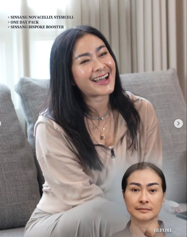 Setelah prosedur wajah Iis jelas terlihat jadi lebih cerah dan kinclong. Kerutan pun tak terlihat menghiasi wajah Iis. Foto: Instagram/@isdadahlia