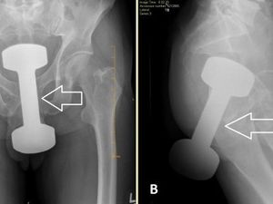 Kisah Dokter Keluarkan Dumbell 2,2 Kg yang Nyangkut di Anus Pria