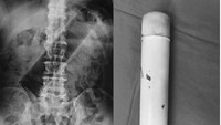 Pria 73 tahun mengeluh benjolan perut, dan operasi menemukan benda semacam botol silindris panjang di dalam kolon desenden. Benda asing dikeluarkan lewat pembedahan kolotomi. (Foto: Malaysia Family Physician)