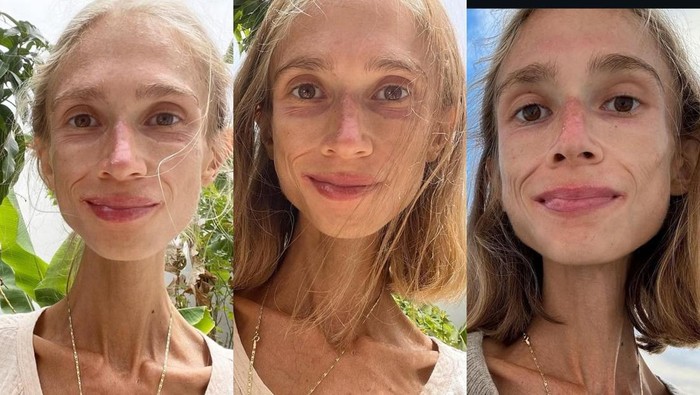 Kondisi Wanita Polandia Sebelum Mati Kelaparan di Bali gegara Diet Buah Ekstrem