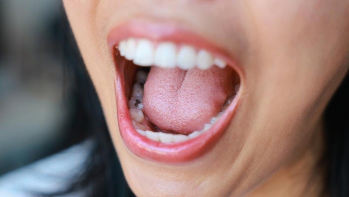 Viral Punya Pasangan Gigi Berlubang Disebut Bisa Menular, Begini Kata Dokter Gigi