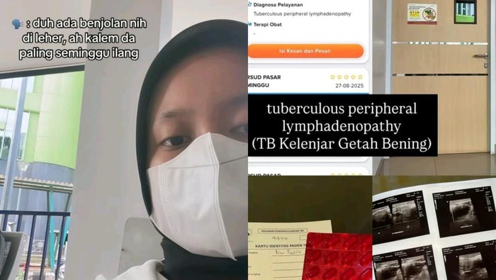 **Viral Wanita Jaksel Kena TB Kelenjar Getah Bening di Usia 25, Gejala Awal yang Harus Diwaspadai**