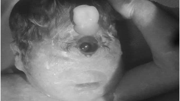 Bayi Ini Terlahir dengan Mata Satu dan Tanpa Hidung, Cuma Bertahan 6 Jam - Update 1
