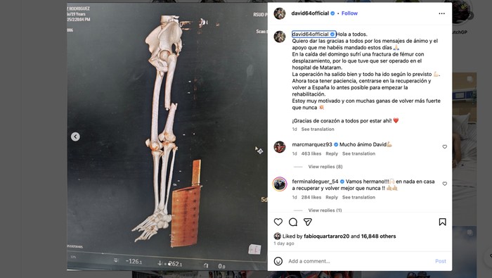 David Munoz mengalami cedera patah tulang paha kiri.