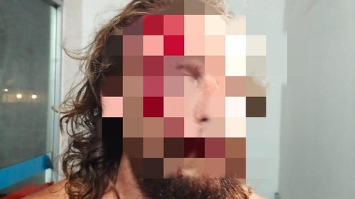 ED (33), WN AS yang menjadi korban penganiayaan di vila Desa Selong Belanak, Kecamatan Praya Barat, Lombok Tengah, NTB, Minggu (19/10/2025). (Dokumentasi warga)