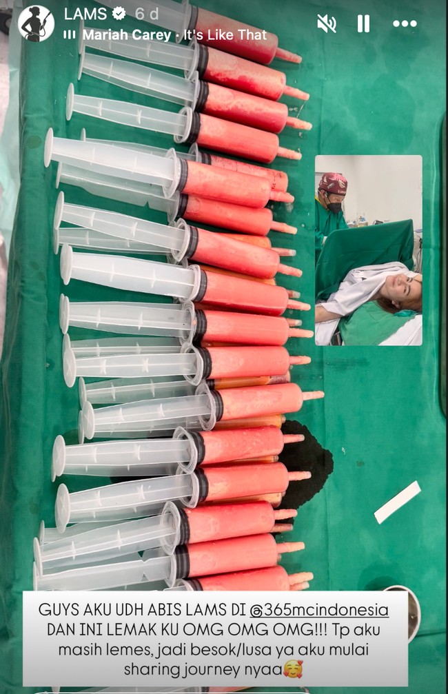 Beberapa waktu lalu artis Felicya Angelista menjalani prosedur Local Anesthetic Minimal-invasif Lipo-suction (LAMS). Prosedur tersebut dipilhnya untuk mengembalikan kepercayaan diri setelah melahirkan 2 orang anak. Foto: Instagram/@felicyangelista_