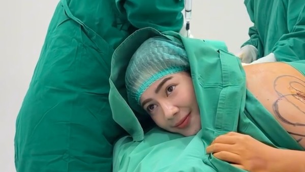 8 Foto Felicya Angelista Jalani Sedot Lemak, Makin Langsing Turun BB 2 Kg