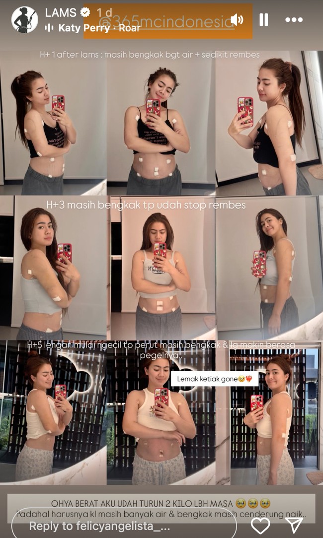 Feli juga membagikan proses perkembangan pemulihan dirinya setelah menjalani prosedur kecantikan tersebut. Terlihat setelah tindakan tubuh Feli dipenuhi dengan plester-plester putih untuk menutup luka akibat tindakan. Foto: Instagram/@felicyangelista_