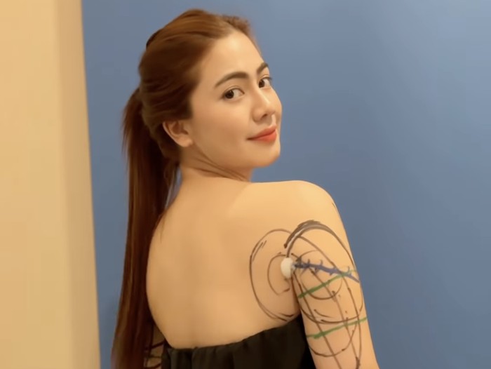 Felicya Angelista Felicya Angelista perihatkan kondisi tubuh setelah melakukan prosedur LAMS.