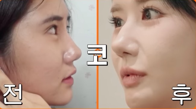 Hingga kini, Gil masih rutin datang ke klinik kulit hampir setiap hari. Ia menganggap rutinitas tersebut sebagai bentuk perawatan diri, bukan lagi obsesi, agar penampilannya tetap terjaga dan membuatnya merasa lebih baik. Foto: YouTube/tvN D ENT