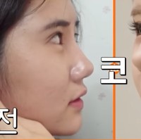 Hingga kini, Gil masih rutin datang ke klinik kulit hampir setiap hari. Ia menganggap rutinitas tersebut sebagai bentuk perawatan diri, bukan lagi obsesi, agar penampilannya tetap terjaga dan membuatnya merasa lebih baik. Foto: YouTube/tvN D ENT