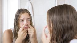 Apakah Jerawat di Bawah Hidung Boleh Dipencet? Ini Fakta yang Wajib Tahu!