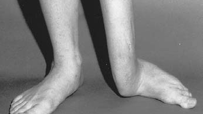 Kasus langka kaki panjang sebelah.