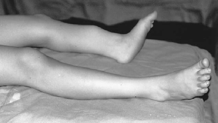 Kasus langka kaki panjang sebelah.