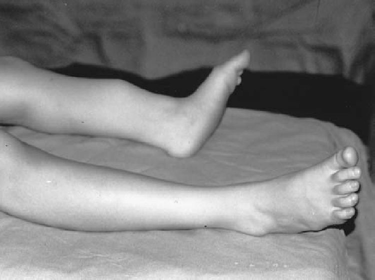 Penampakan Bocah Idap Kondisi Langka, Kakinya Panjang Sebelah